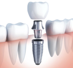 titanium based cylinder - Dental Implant