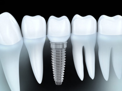 artificial Teeth Dental Implant