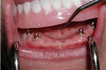 Traditional Denture Treatment
