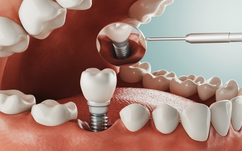 Teeth Implant Treatment